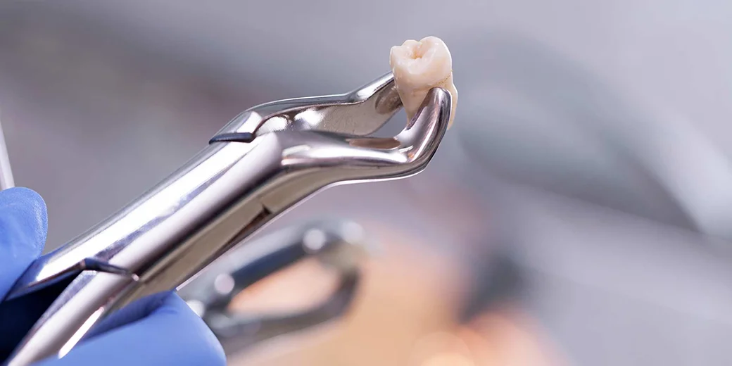 What to Do After Tooth Extraction?